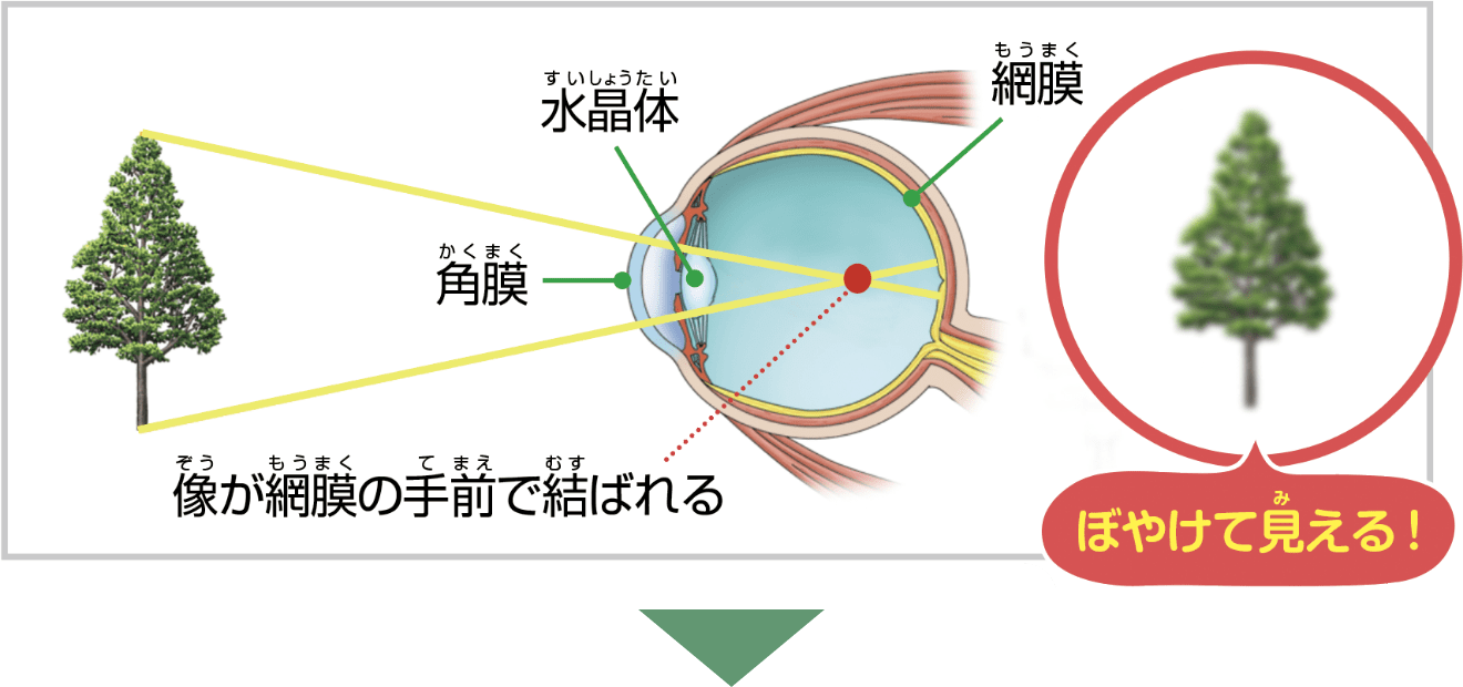 近視の場合