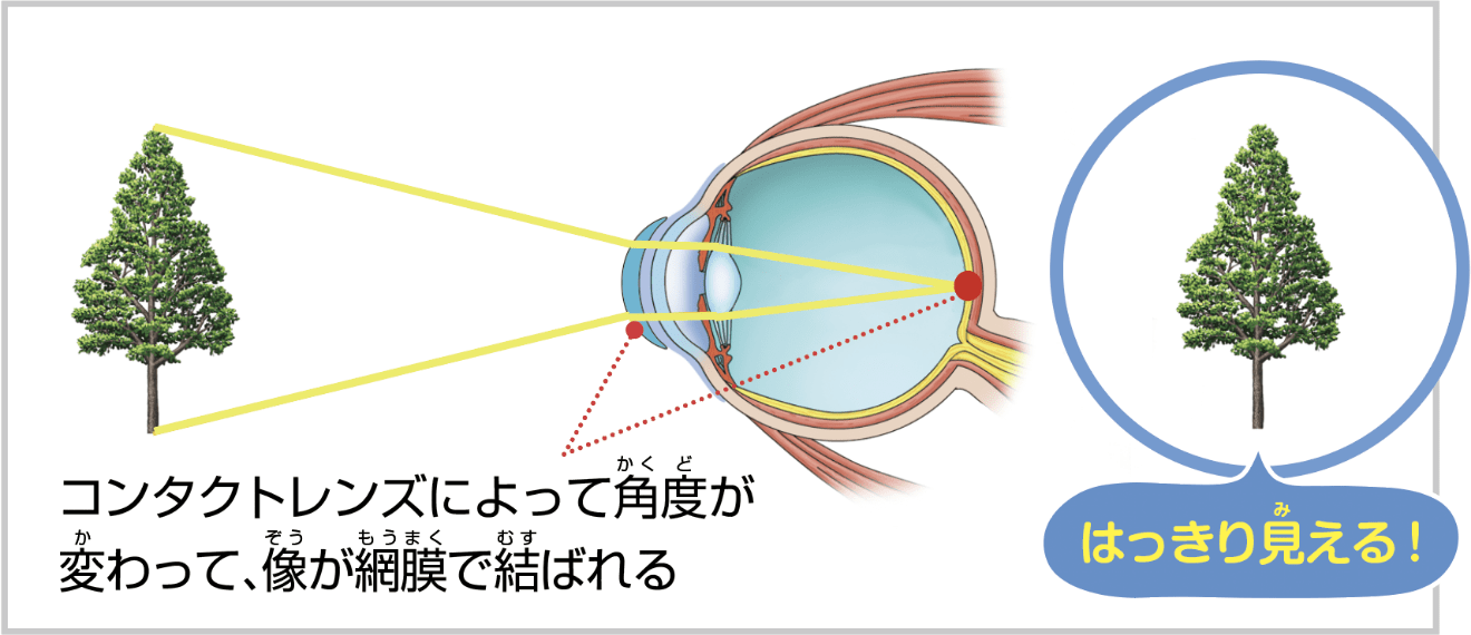 コンタクトレンズをつけると