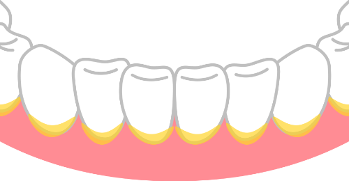 歯と歯ぐきの境目
