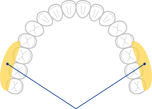 上の奥歯の外側